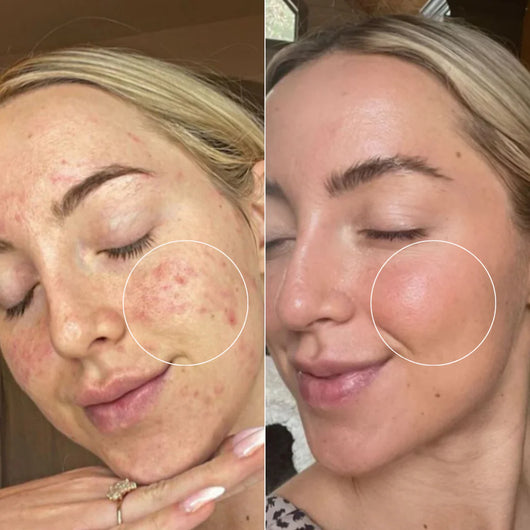 MINDBODYSKIN Hormonal Acne Supplement
