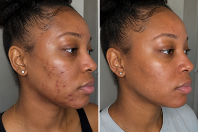 MINDBODYSKIN Hormonal Acne Supplement