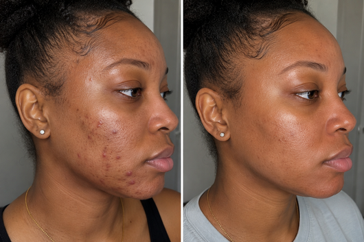 MINDBODYSKIN Hormonal Acne Supplement