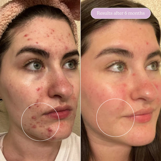 MINDBODYSKIN Hormonal Acne Supplement